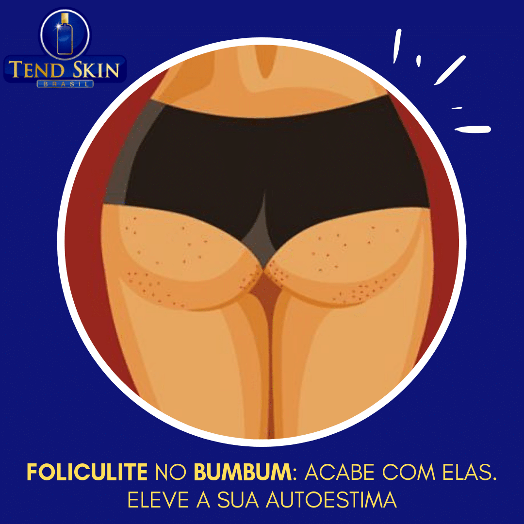 Foliculite: Foliculite no bumbum: acabe com elas. Eleve a sua autoestima 2 Foliculite: Foliculite no bumbum: acabe com elas. Eleve a sua autoestima 1