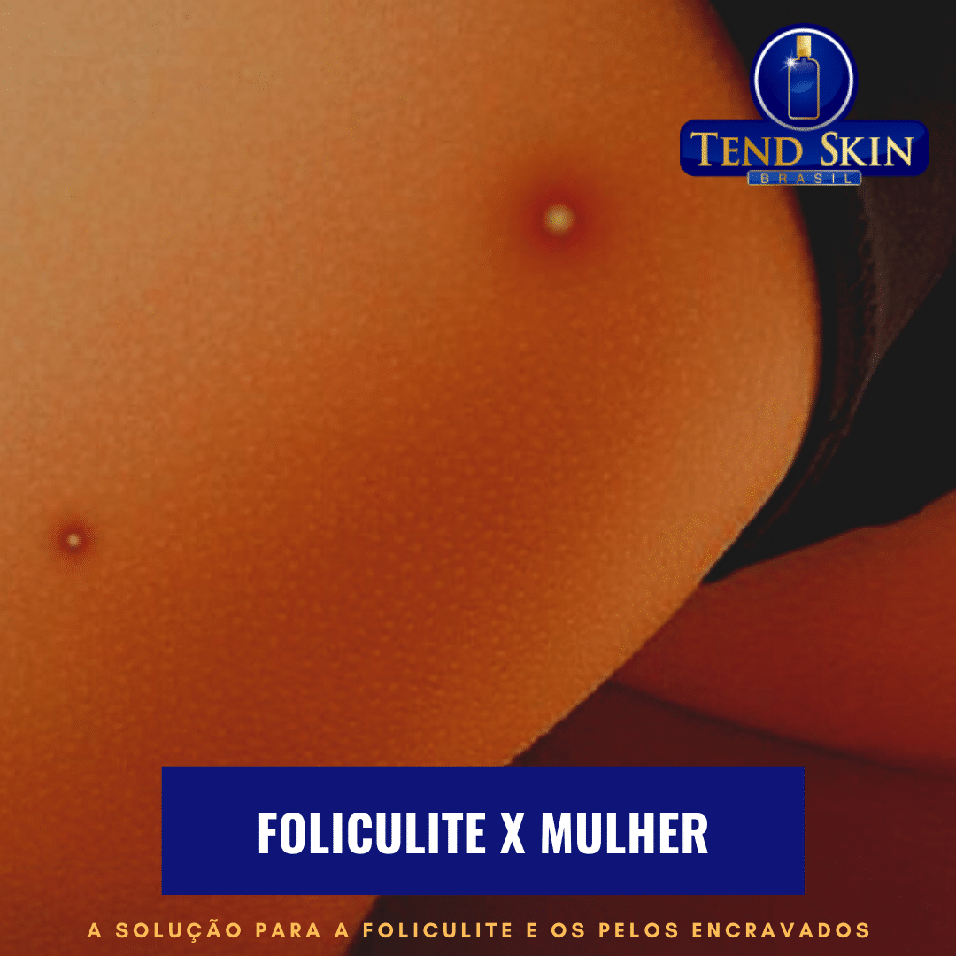 Foliculite: Foliculite X mulher 2 Foliculite: Foliculite X mulher 1
