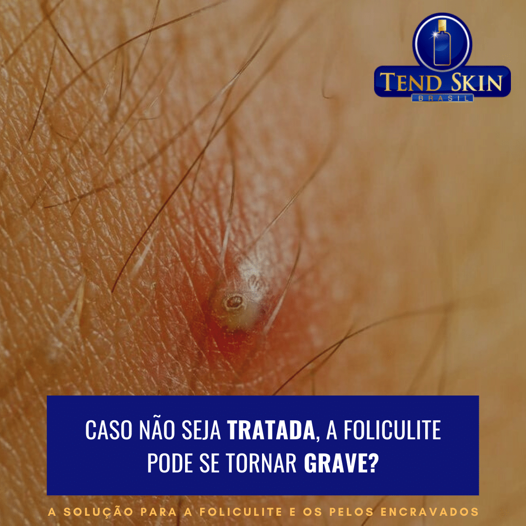 Foliculite: Caso não seja tratada, a foliculite pode se tornar grave? 2 Foliculite: Caso não seja tratada, a foliculite pode se tornar grave? 1