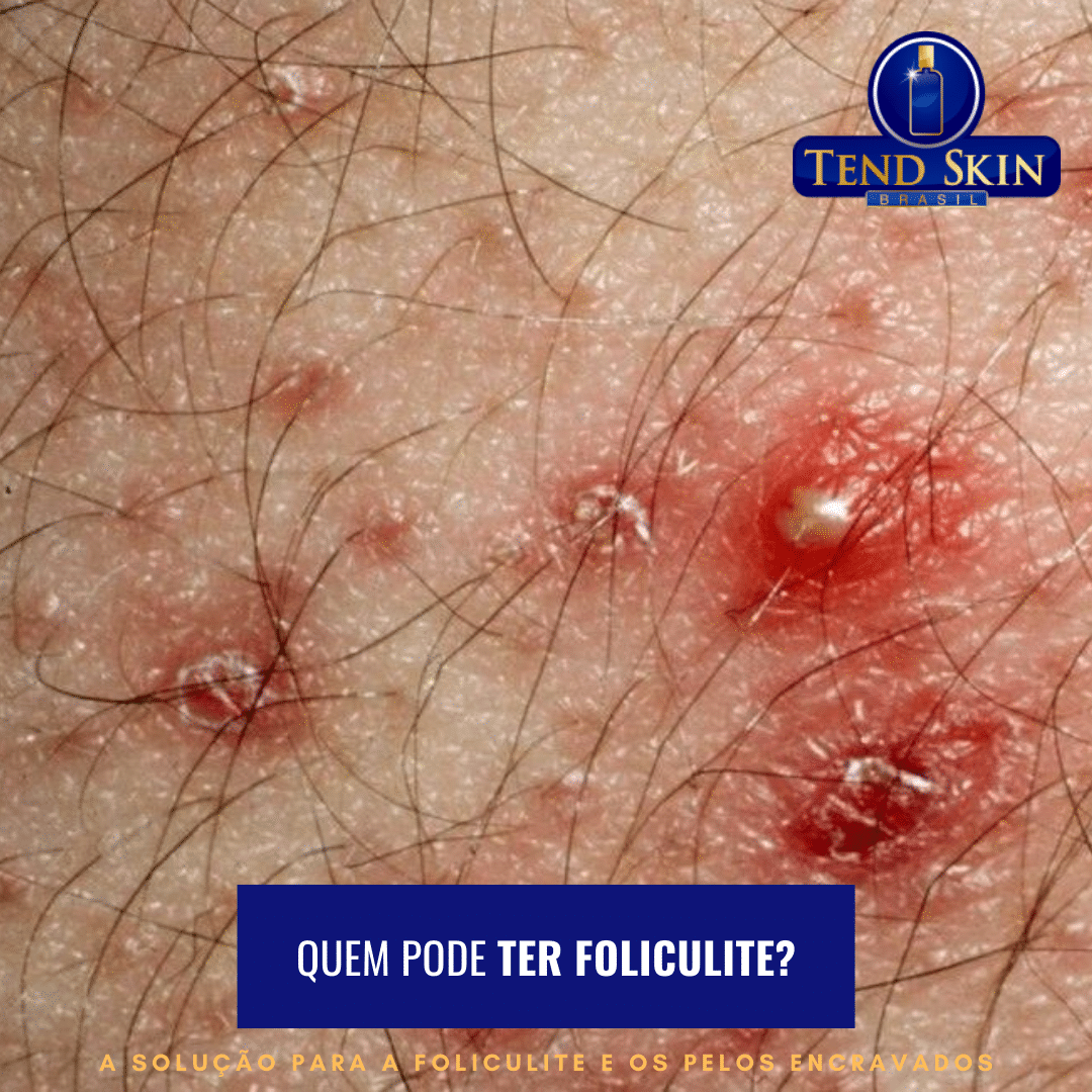 Foliculite: Quem pode ter foliculite? 2 Foliculite: Quem pode ter foliculite? 1