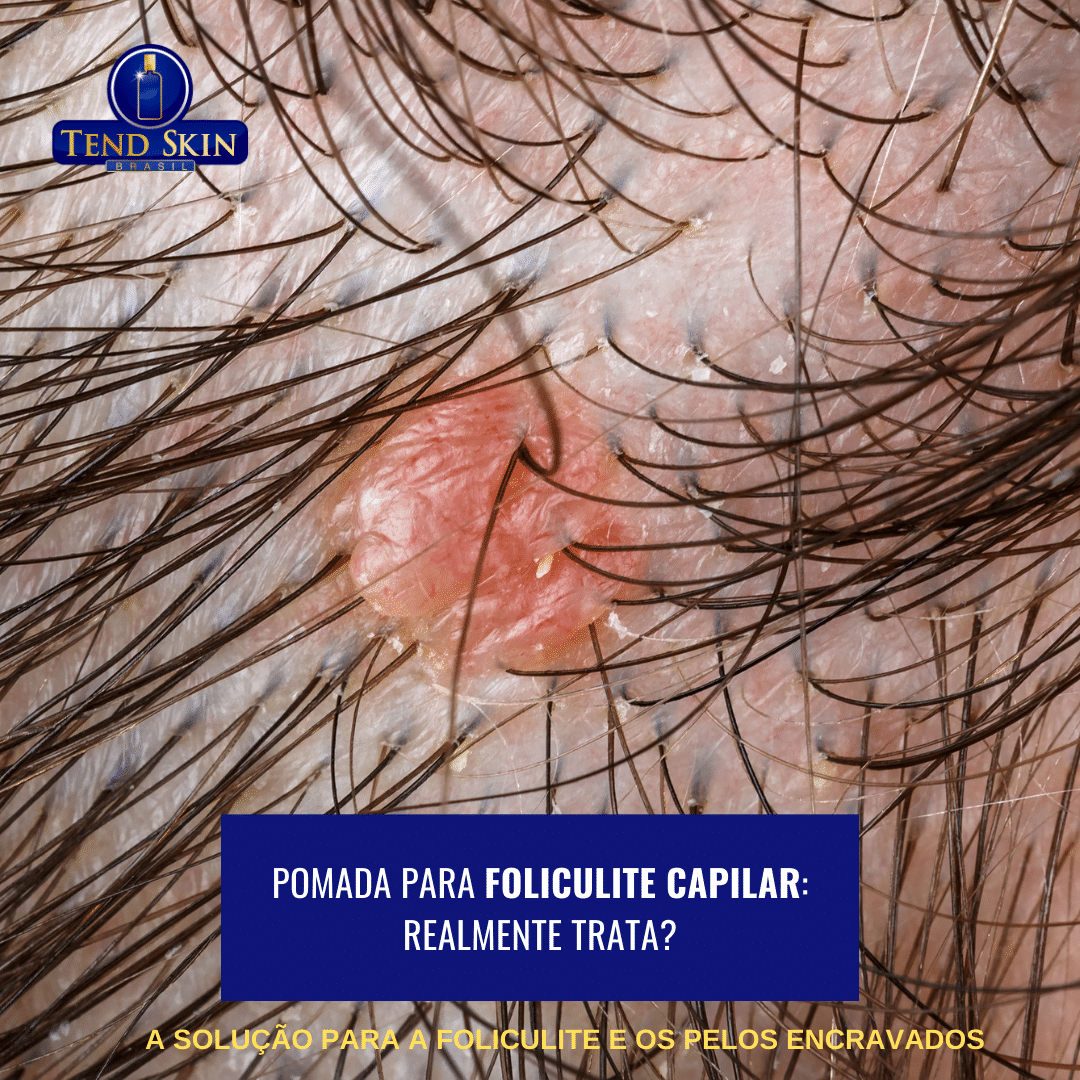 Foliculite: Remédio para foliculite capilar: realmente trata? 1 Remédio para foliculite capilar