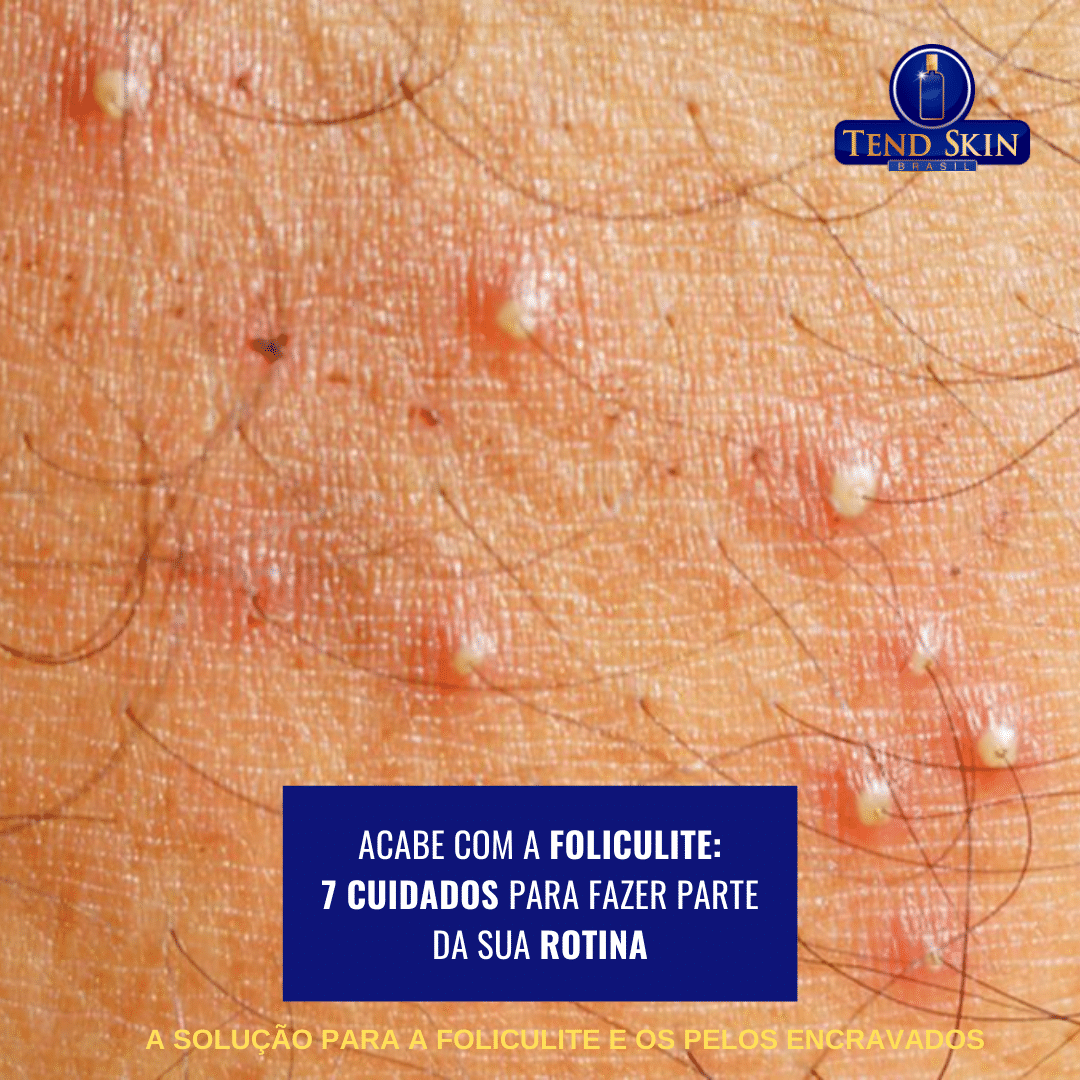 Foliculite: Acabe com a foliculite: 7 cuidados para fazer parte da sua rotina 2 Foliculite: Acabe com a foliculite: 7 cuidados para fazer parte da sua rotina 1