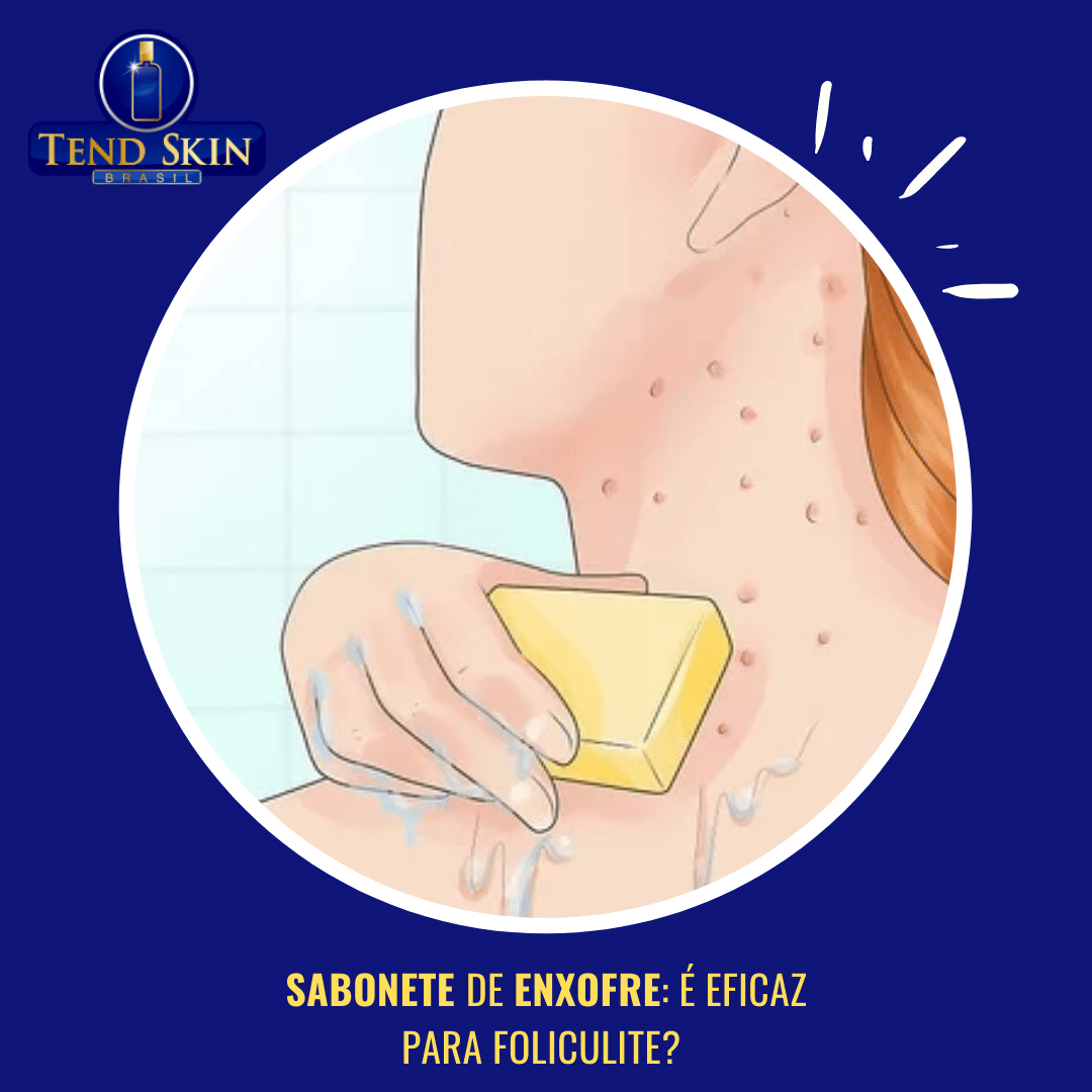 Foliculite: Sabonete de enxofre: é eficaz para foliculite? 2 Foliculite: Sabonete de enxofre: é eficaz para foliculite? 1