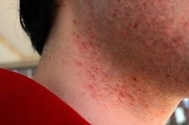 Foliculite: O que é Foliculite e quais os Tratamentos para Foliculite? 2 Foliculite na Barba