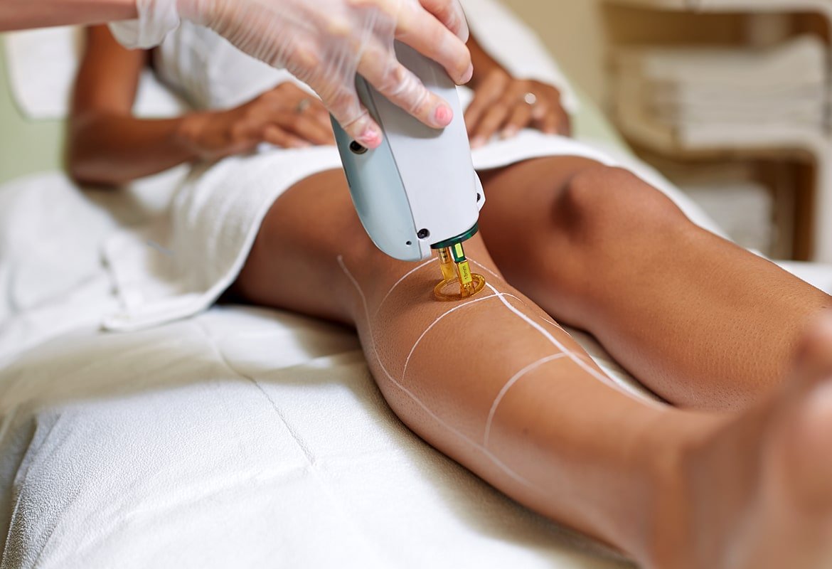 Foliculite: Tend Skin ajuda na recuperação da depilação a laser 2 Foliculite: Tend Skin ajuda na recuperação da depilação a laser 1