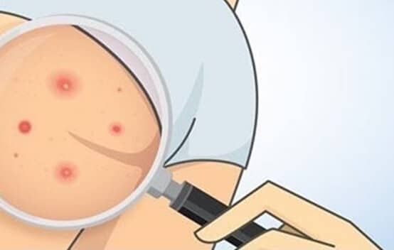 Tend Skin Foliculite nas nádegas