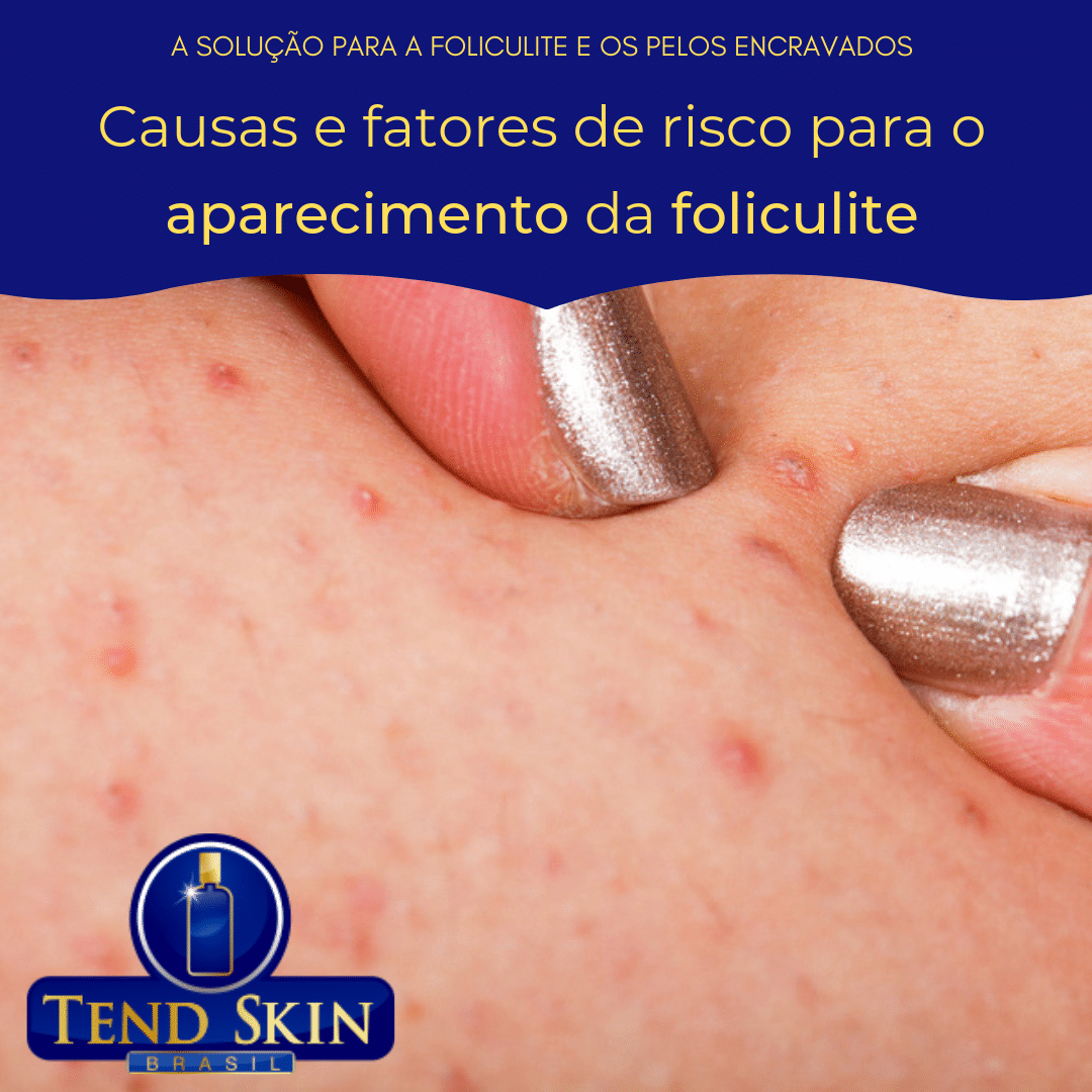 Foliculite: Causas e fatores de risco para o aparecimento da foliculite 2 Foliculite: Causas e fatores de risco para o aparecimento da foliculite 1