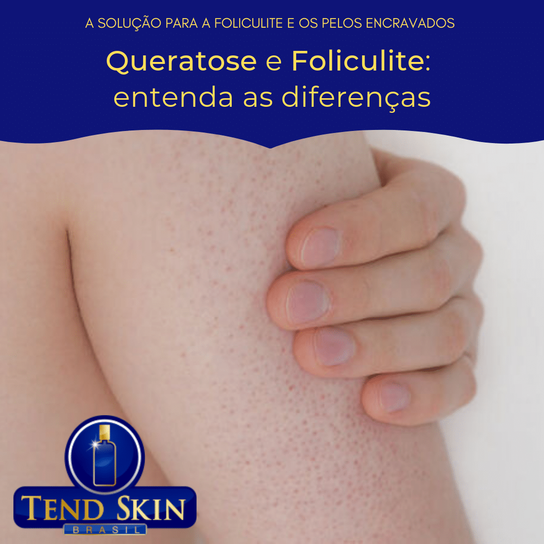 Foliculite: Queratose e Foliculite: entenda as diferenças 2 Foliculite: Queratose e Foliculite: entenda as diferenças 1