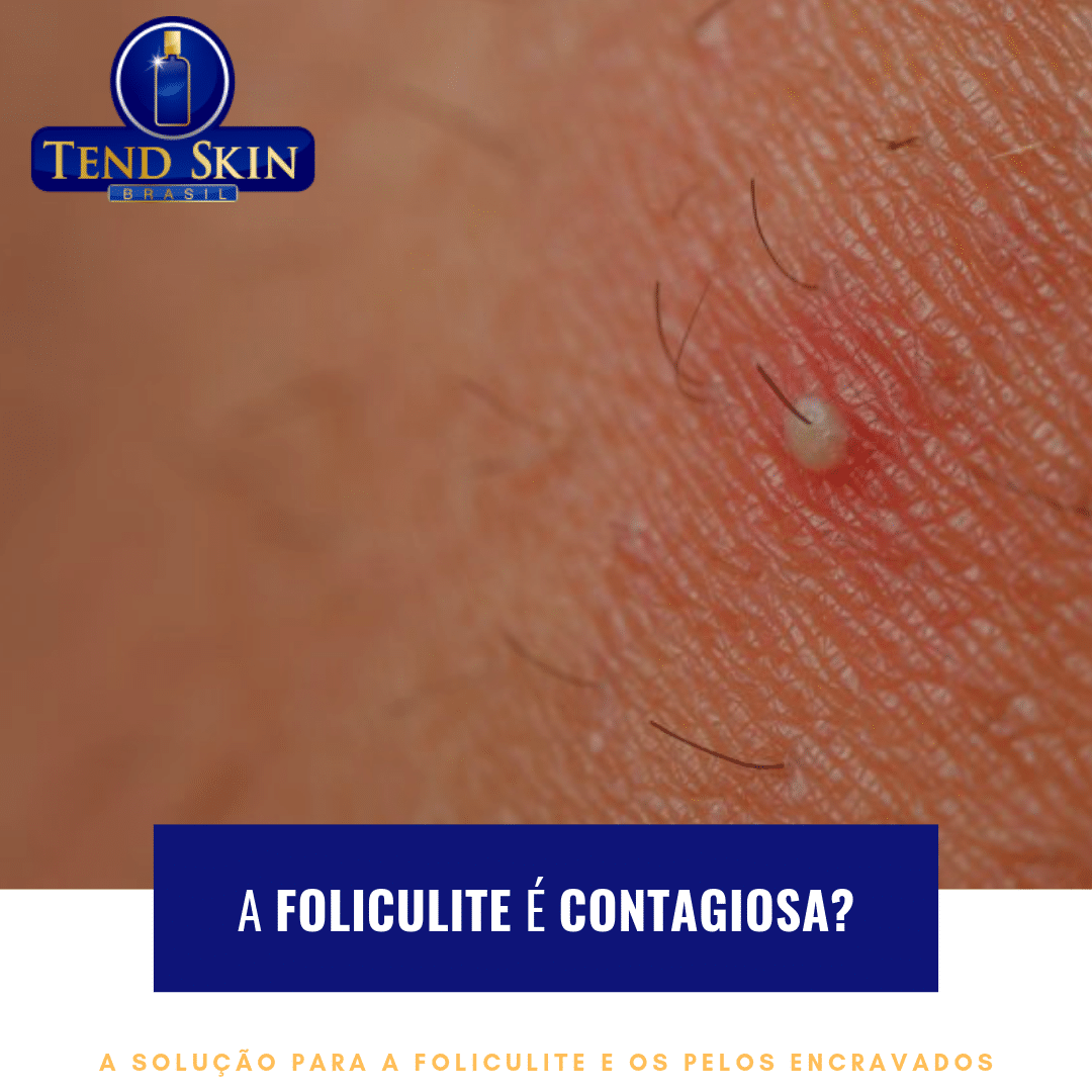 Foliculite: A foliculite é contagiosa? 2 Foliculite: A foliculite é contagiosa? 1