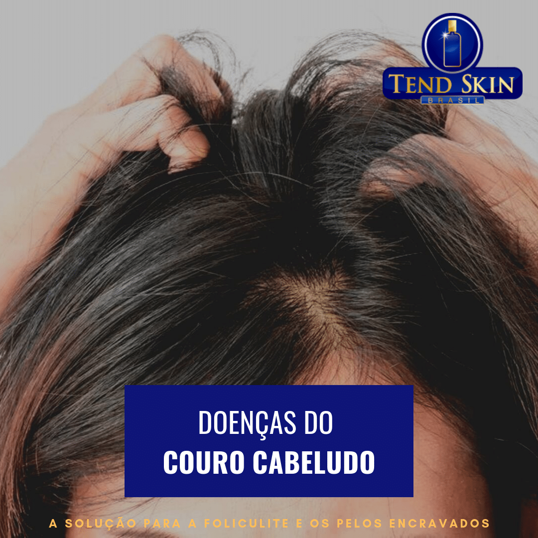 Foliculite: Doenças do couro cabeludo 2 Foliculite: Doenças do couro cabeludo 1