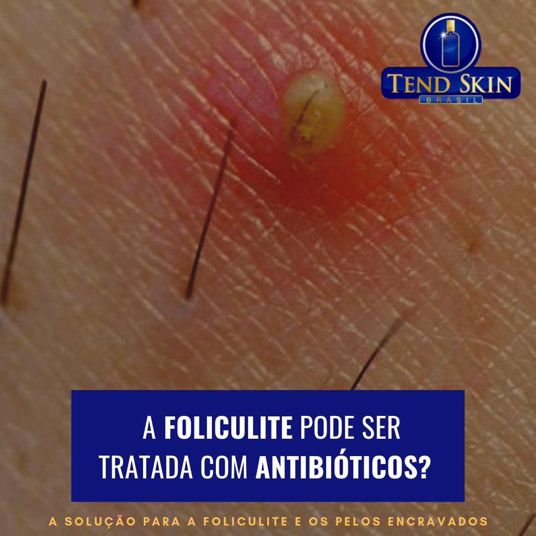 Foliculite: A foliculite pode ser tratada com antibióticos? 2 Foliculite: A foliculite pode ser tratada com antibióticos? 1
