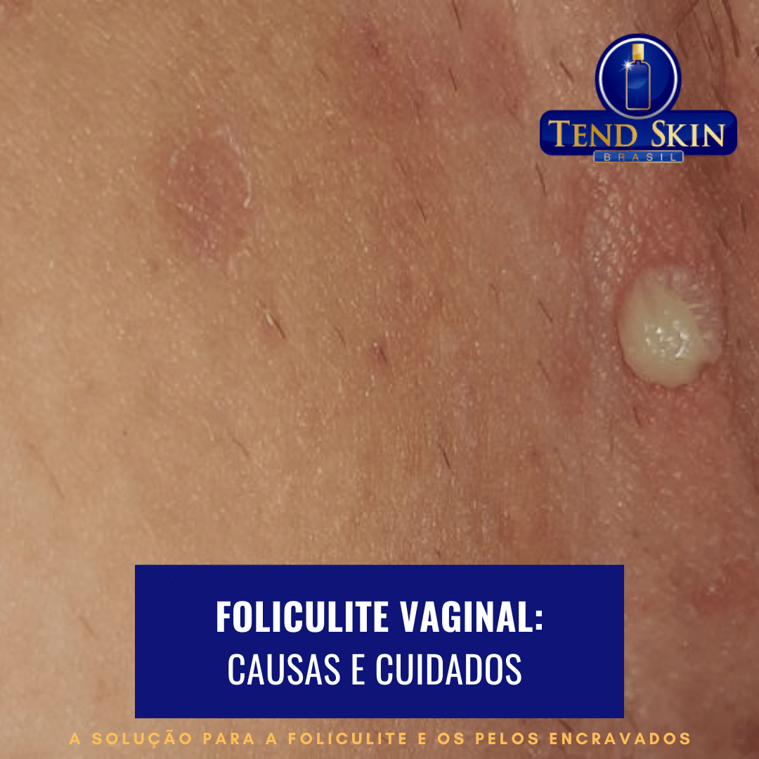 Foliculite: Foliculite vaginal: causas e cuidados 2 Foliculite: Foliculite vaginal: causas e cuidados 1