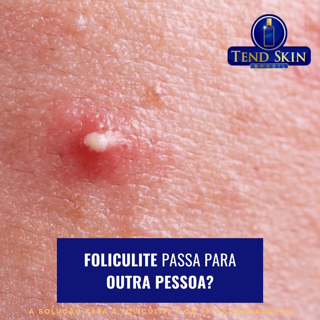 Foliculite: Foliculite passa para outra pessoa? 2 Foliculite: Foliculite passa para outra pessoa? 1