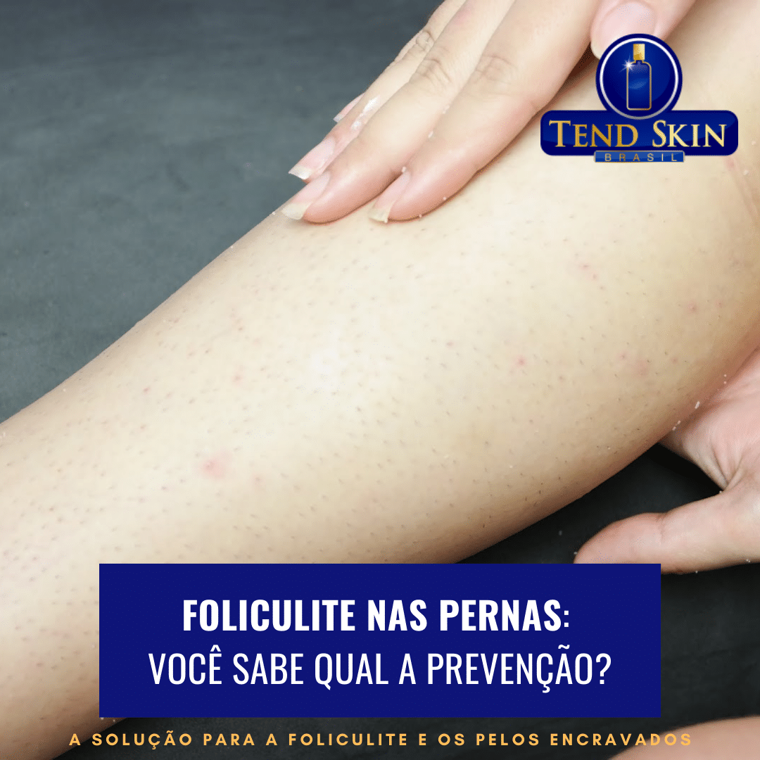 Foliculite: Foliculite nas pernas: você sabe qual a prevenção? 2 Foliculite: Foliculite nas pernas: você sabe qual a prevenção? 1