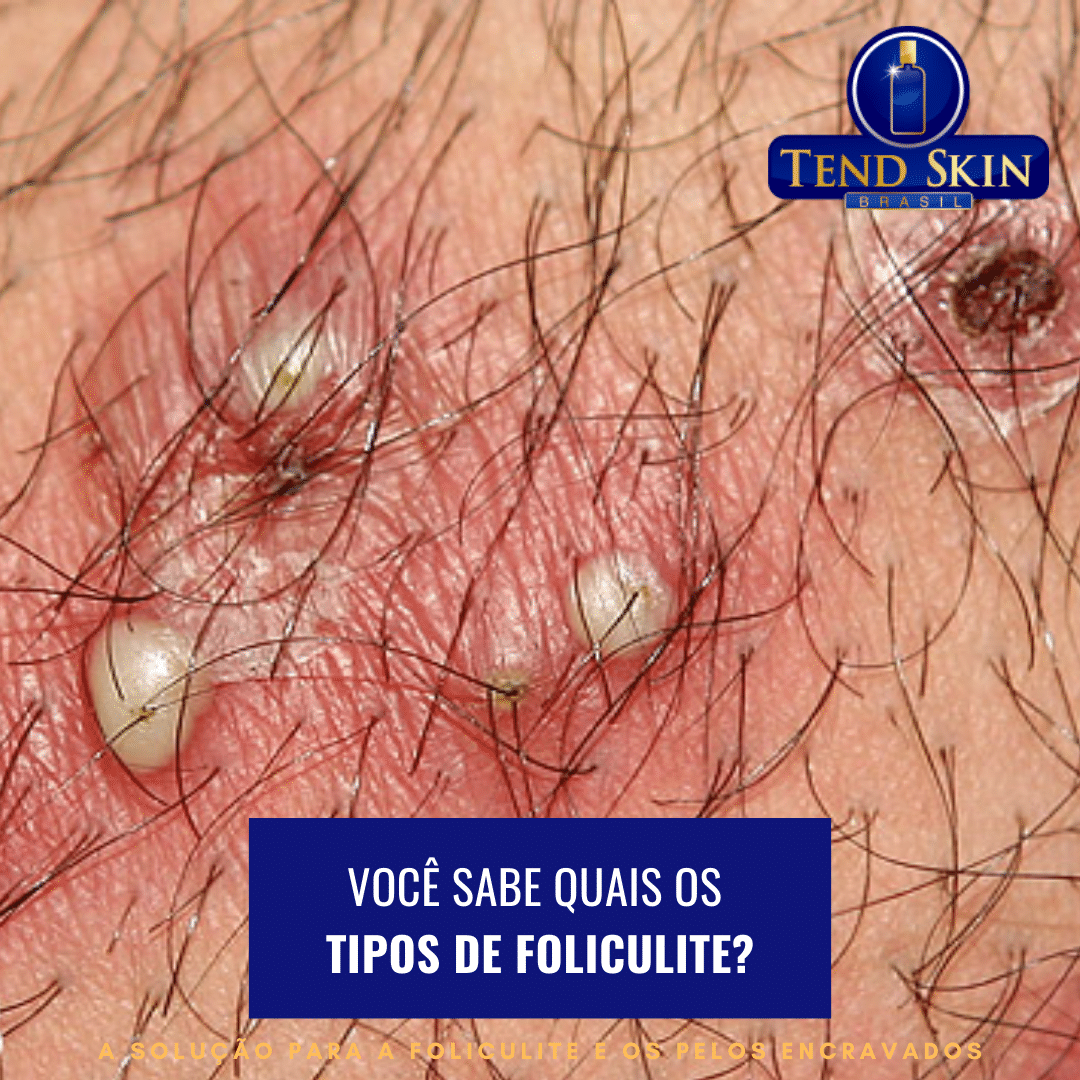 Foliculite: Você sabe quais os tipos de foliculite? 2 Foliculite: Você sabe quais os tipos de foliculite? 1