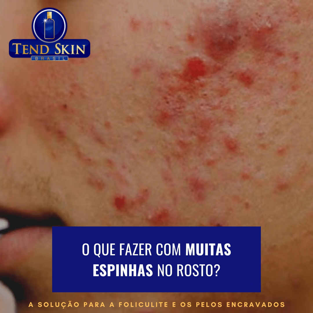 Foliculite: O que fazer com muitas espinhas no rosto? 2 Foliculite: O que fazer com muitas espinhas no rosto? 1