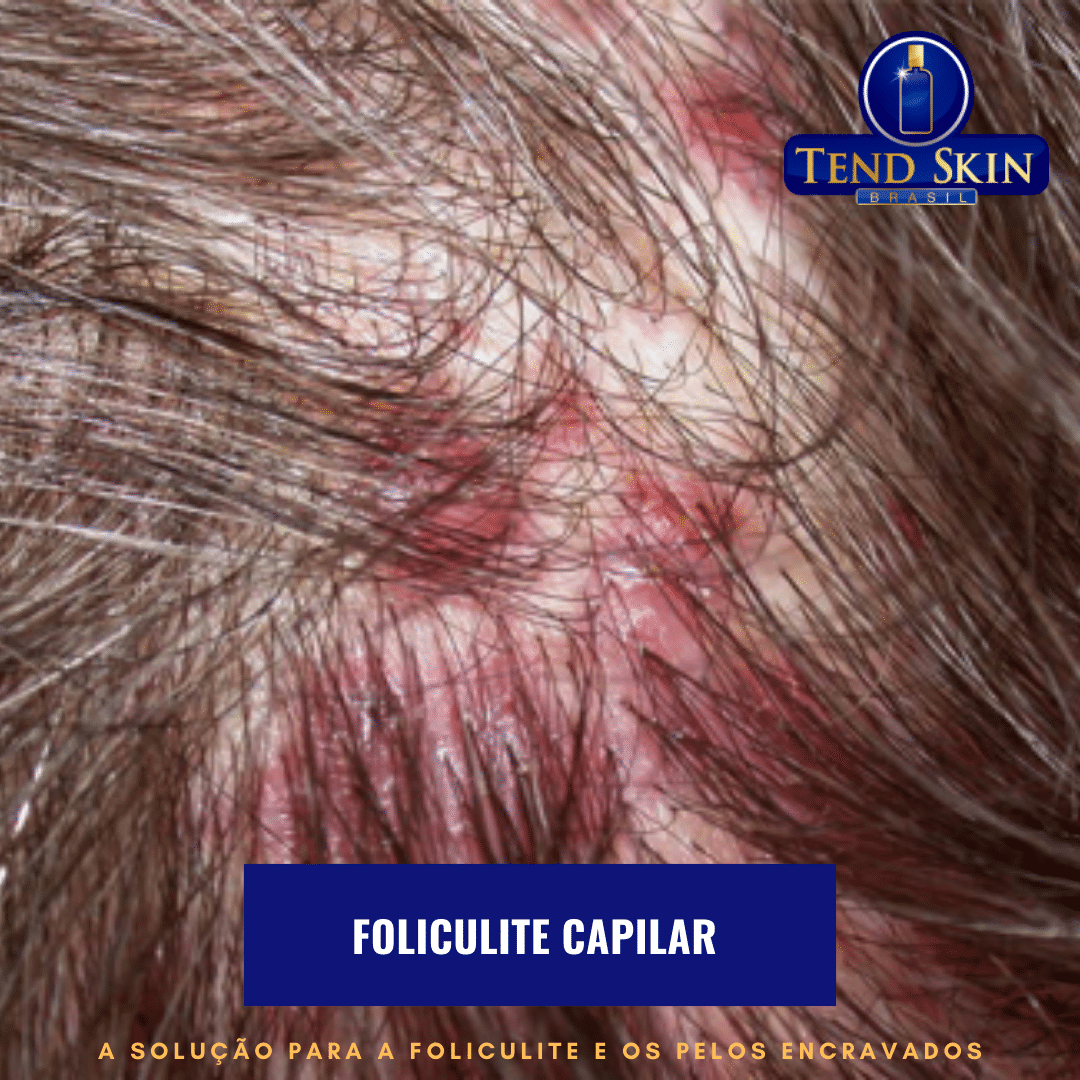 Foliculite: Foliculite capilar 2 Foliculite: Foliculite capilar 1