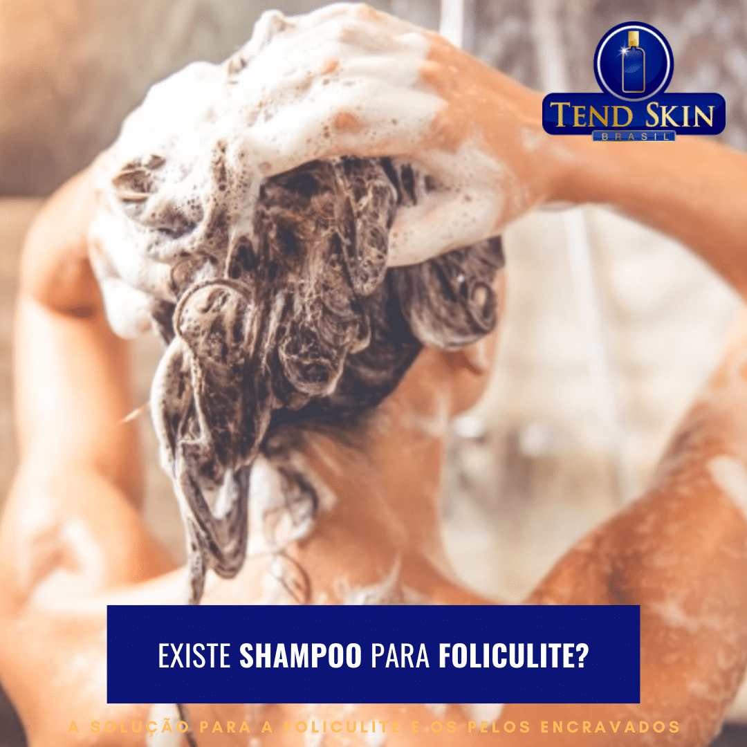 Foliculite: Tend Skin pode passado também no couro cabeludo 2 Foliculite: Tend Skin pode passado também no couro cabeludo 1