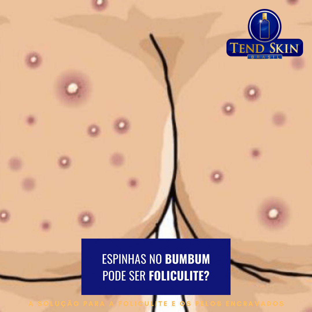 Foliculite: Espinhas no bumbum pode ser foliculite? 2 Foliculite: Espinhas no bumbum pode ser foliculite? 1