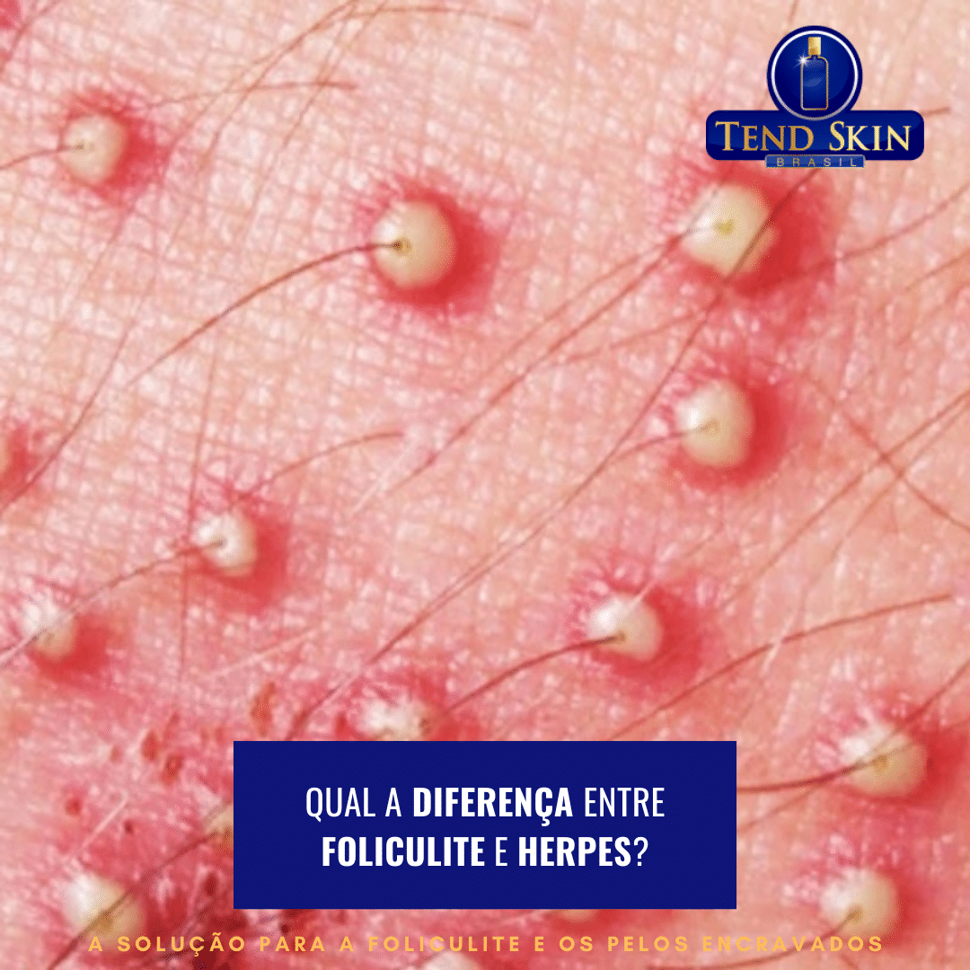 Como saber se é foliculite ou herpes?