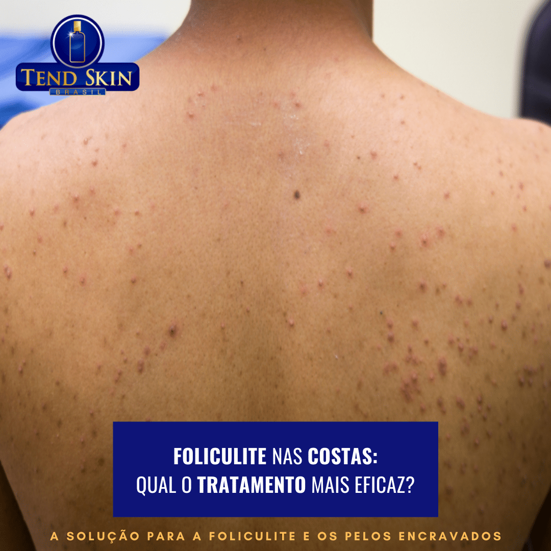 Foliculite: Foliculite nas costas: qual o tratamento mais eficaz? 2 Foliculite: Foliculite nas costas: qual o tratamento mais eficaz? 1