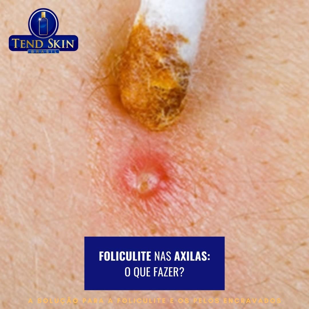 Foliculite: Foliculite nas axilas: o que fazer? 2 Foliculite: Foliculite nas axilas: o que fazer? 1