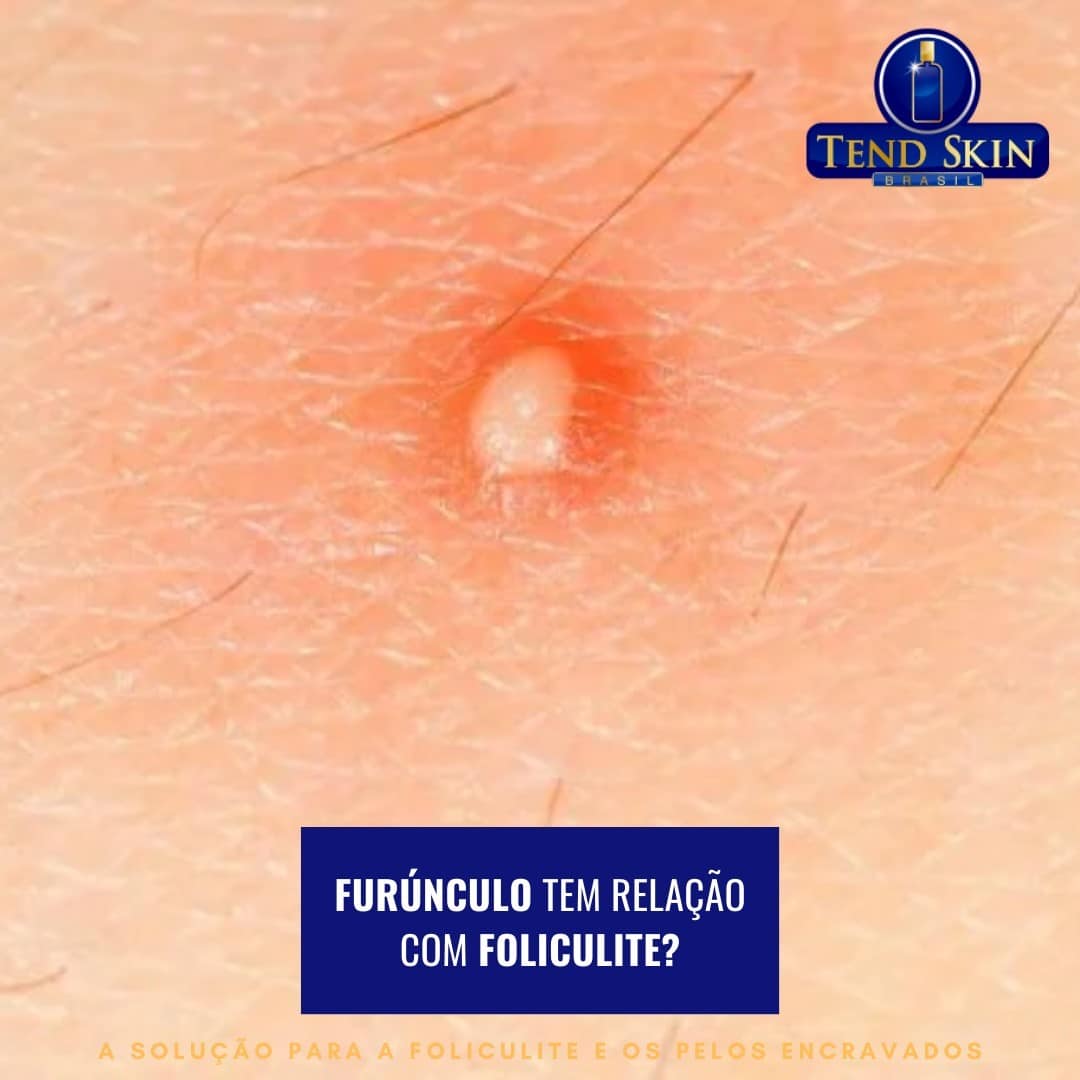 Foliculite: Furúnculo tem relação com foliculite? 2 Foliculite: Furúnculo tem relação com foliculite? 1