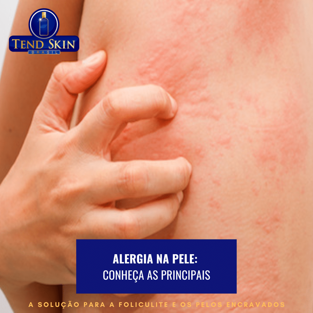 Foliculite: Alergia na pele: conheça as principais 2 Foliculite: Alergia na pele: conheça as principais 1