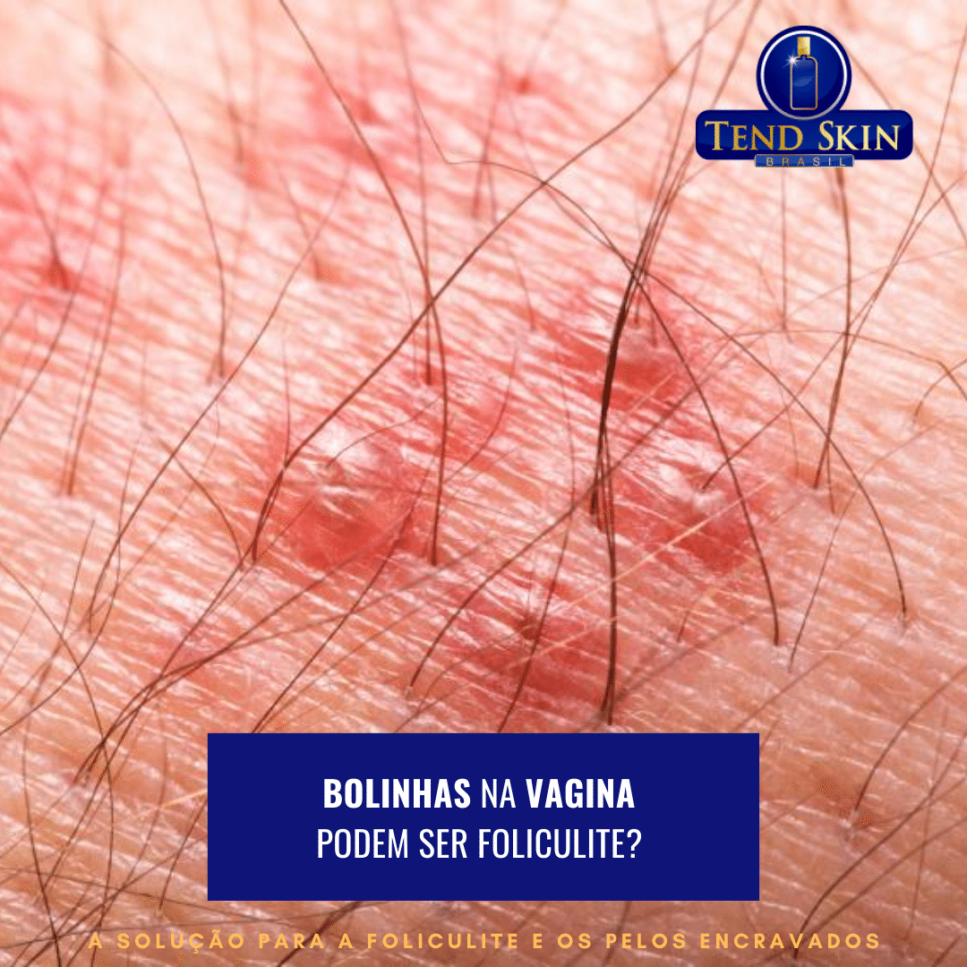 Foliculite: Bolinhas na vagina podem ser foliculite? 2 Foliculite: Bolinhas na vagina podem ser foliculite? 1