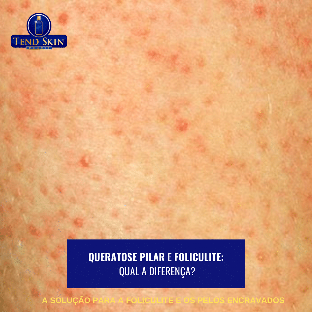 Foliculite: Queratose pilar e foliculite: qual a diferença? 2 Foliculite: Queratose pilar e foliculite: qual a diferença? 1