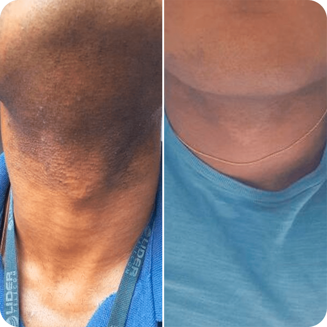 Tend Skin Antes E Depois Confira 10 Fotos Reais!